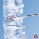 Vertecem V+